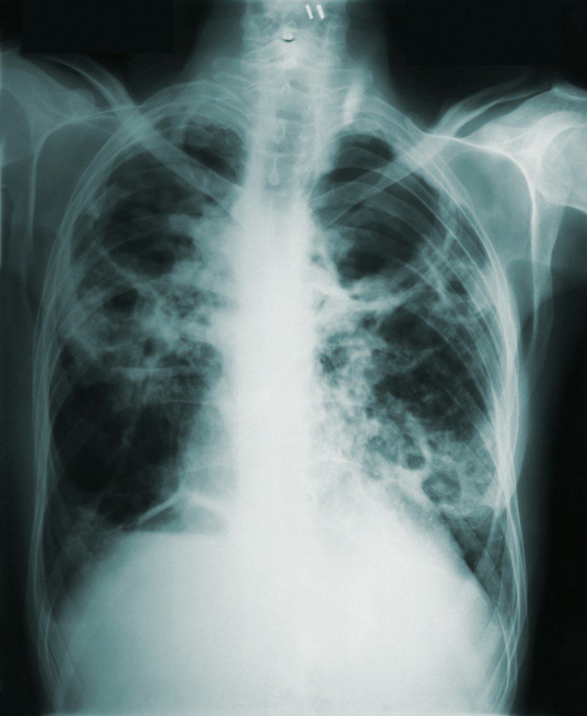 Système de Détection de la Tuberculose